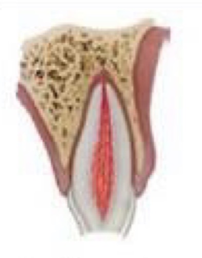 <p>Fracture confined to enamel and dentin without pulp exposure</p><p>If fragment intact- bond back- should be rehydrated by soaking in water or saline for 20mins before</p><p>Cover exposed dentin with GIC or using bond + composite</p><p>If exposed dentin within 0.5mm of pulp (pink no bleeding)place CaOH</p>