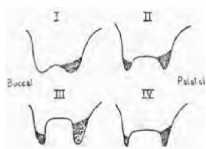 <p>CLASS 1 (2-3 mm): Normal- minimal reduction in PT</p><p>CLASS 2 (4-5 mm): Concave- minimal red in PT (2-3mm) and VB</p><p>CLASS 3 (6-7 mm): Advanced lesion- minimal red in VB, up to level of PT furcation (sacrifices support)</p><p>CLASS 4: Concave with very thin VB and PT walls- red similar to class 3 but with less volume </p>