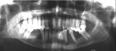 <p>describe the effect of the lesion:</p>