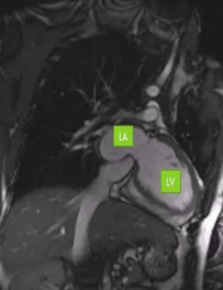 <ul><li><p>2 chamber view </p></li><li><p>LA and LV </p></li><li><p>LV → mitral valve → LA </p></li></ul><p></p>