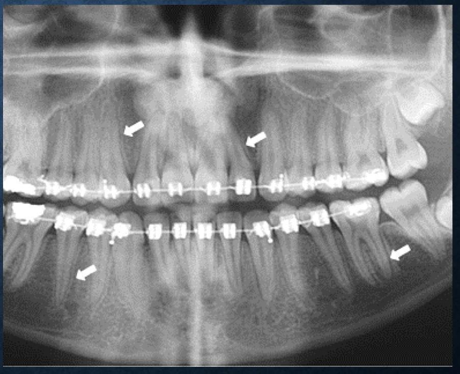 <p>orthodontic movement</p>