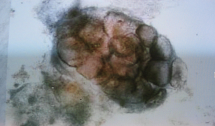 <p>⚠️‼️(#17,#32,#37)79.This pathognomonic lesion can be seen in infections caused by: A.Lymphogranuloma venereum B.Granuloma inguinale C.Herpes simplex D.Syphilis</p>