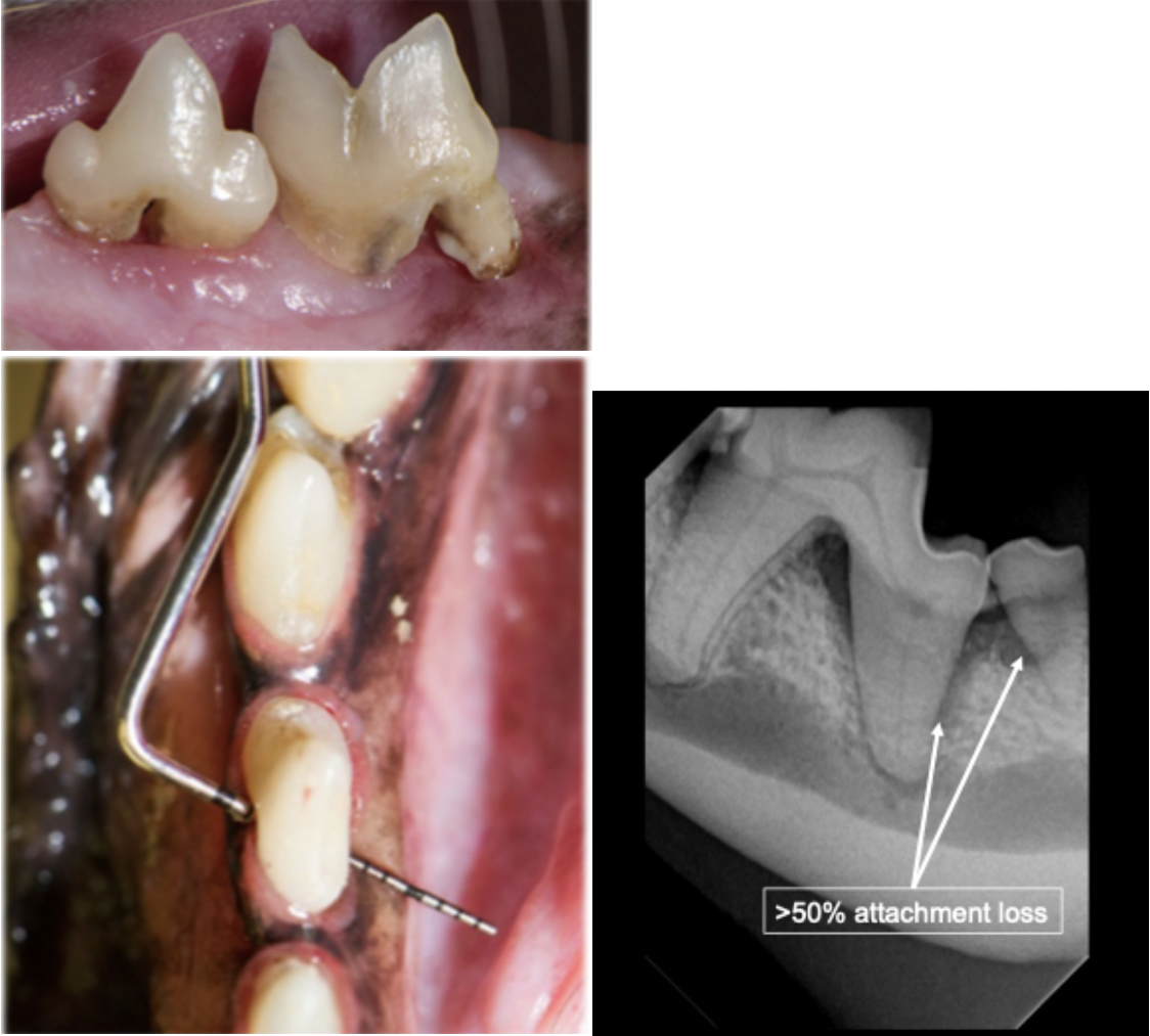 <p>What is the stage of periodontal disease shown in this image?</p>