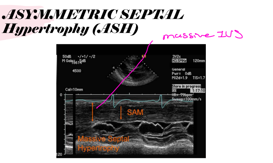 <p>ASYMMETRIC SEPTAL Hypertrophy (ASH)</p><p>Massive IVS and Massive septal hypertrophy </p>