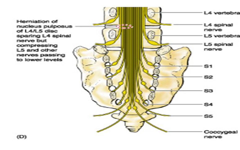 <ul><li><p>when small, an HNP usually affects spinal nerve whose number corresponds to the number of the vertebra below the disc</p></li><li><p>i.e. HNP at L5/S1 (most common) will usually affect S1</p></li></ul><p></p>