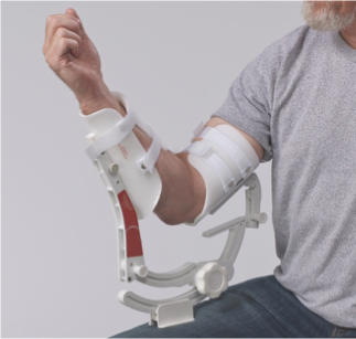 <p>flexion contracture» <strong>JOINT STUCK IN BENT POSITION</strong>, <span>Limited active and passive extension aka </span></p><p><span>Soft tissue restrictions</span></p><p></p><p>extension contracture» <strong>JOINT STUCK IN EXTENDED</strong> <span>Position of extension with limited flexion</span></p><p><span>Significantly impact function</span></p><p></p><p><span>(extension comes w a bit more difficulties) </span></p><ul><li><p><span>Difficulty feeding themselves</span></p></li><li><p><span>Difficulty washing their hair</span></p></li><li><p><span>Difficulty lifting and carrying</span></p></li><li><p><span>Difficulty using an ATM</span></p></li></ul><p></p>