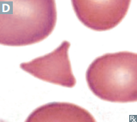 <p>Microangiopathic hemolytic anemia, e.g. DIC; TTP/HUS; HELLP syndrome; mechanical hemolysis such as prosthetic heart valves</p>
