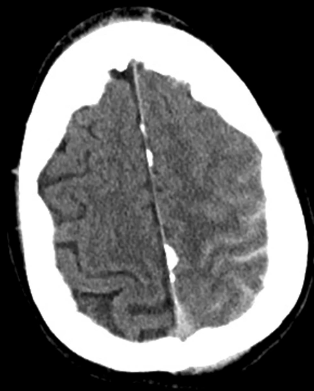 <p>artery or vein rupture that causes accumulation of blood in the arachnoid space where just CSF should be</p>