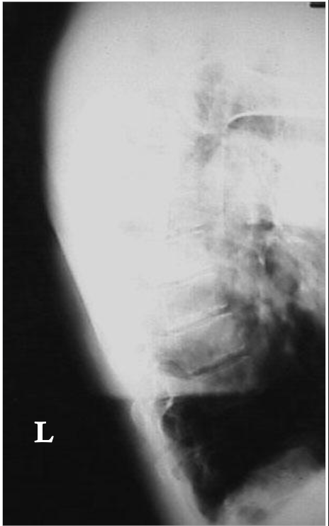 <p>Is this film of diagnostic quality (Lateral Thoracic)</p>