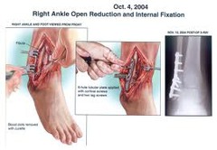 <p>open reduction internal fixation</p>