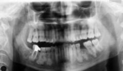 <p>Is this lesion localized or generalized? What condition?</p>