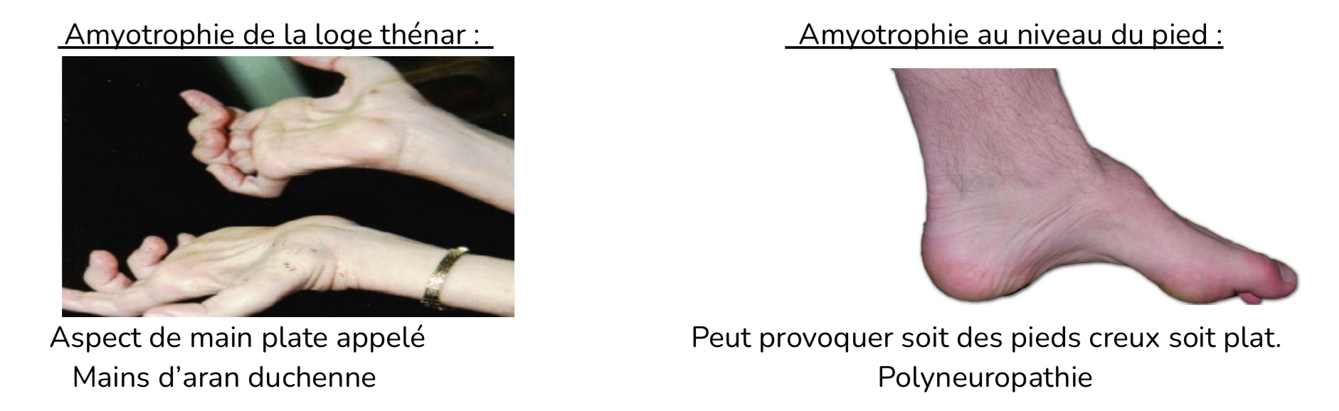 <ul><li><p>amyotrophie de la loge thénar </p><ul><li><p>Aspect de la main plate appelée main d’aran duchenne </p></li></ul></li><li><p>amyotrophie au niveau du pied</p><ul><li><p>Peut provoquer soit des pieds creux soit des pieds plats </p></li></ul></li><li><p>Ce sont des neuropathie héréditaires appelé Charco-Marie-Tooth</p></li></ul><p></p>