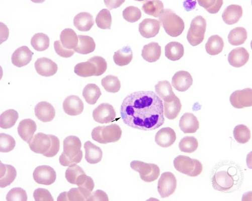 <p>Aggregates of ribosomal rER that appear in the peripheral cytoplasm of neutrophils</p><p>Blue-grey, rod-shaped, or oval inclusions</p>