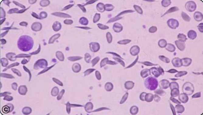 <p>What is the predominant abnormal RBC shape shown? What type of hemoglobin does it have? Why does it form this shape?</p>