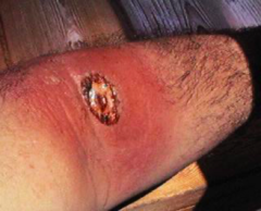 <p>chiefly cytotoxic causing local tissue destruction and an intense inflammatory response</p>