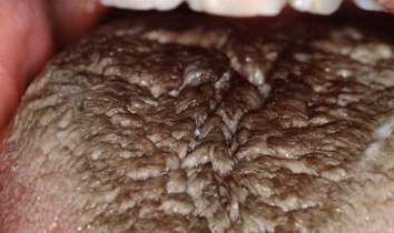 <p>excess keratin on surface of filiform papillae; starts white, may become black, brown, orange, green, yellow</p>