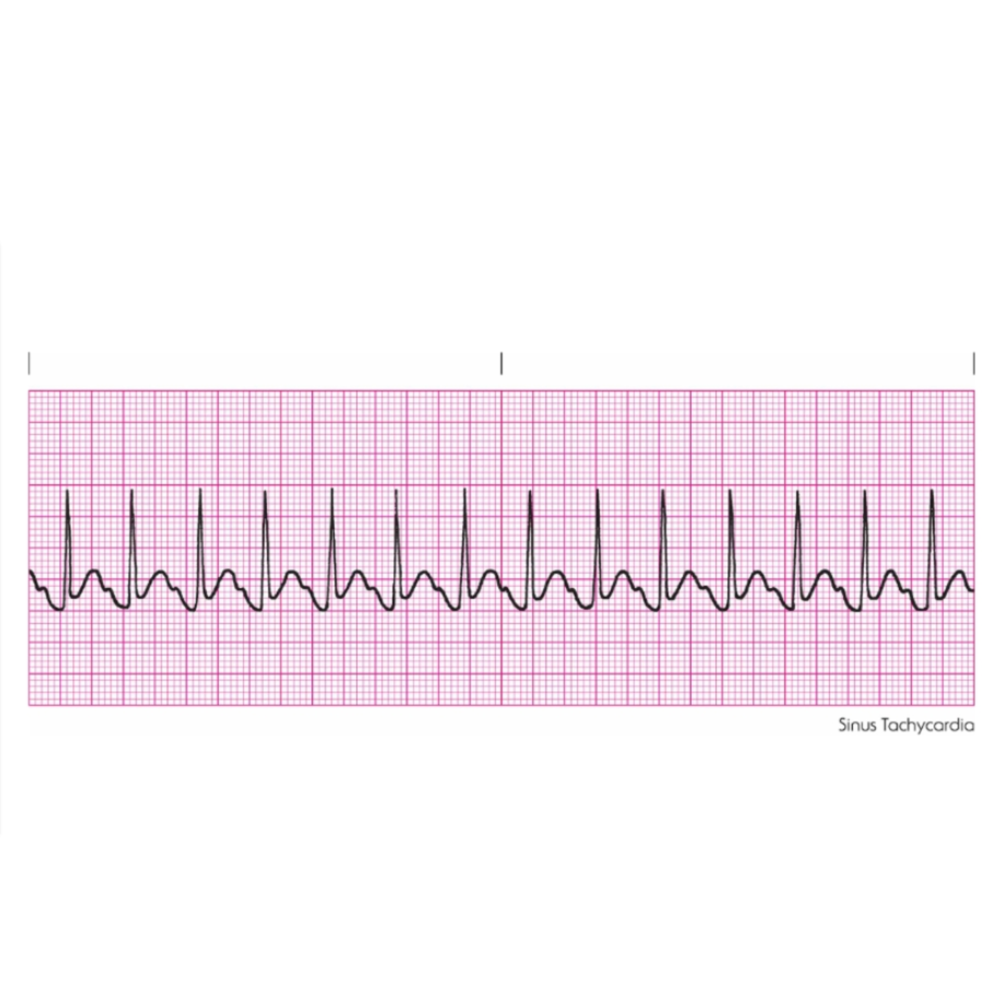 <p>Rules for Sinus Tachycardia includes </p>