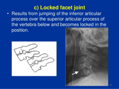 <p>results from jumping of the inferior articular process over the superior articular process of the vertebra below and becomes locked in the position</p>