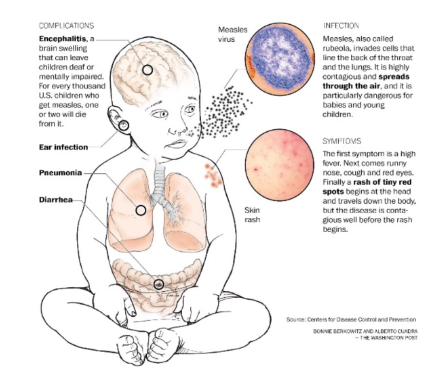 <p>Measles: subacute sclerosing panencephalitis (SSPE)</p>