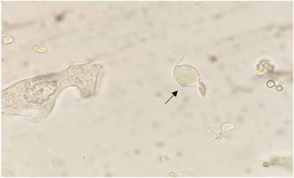 <p>A flagellated protozoan parasite in urine sediment recognized on fresh wet mounts by its rapid darting motility, undulating membrane, and anterior flagella.</p>