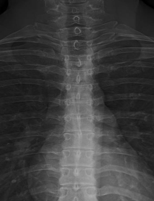 <p>Anterior Posterior Thoracic Landmarks</p>