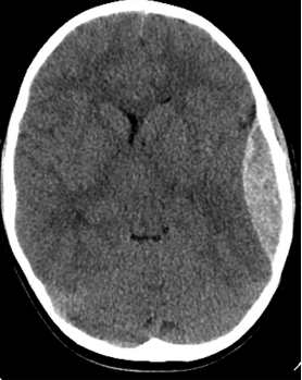 <p>accumulation of blood in cranial epidural space</p>