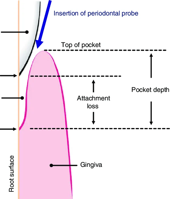<p><span>Gingival groove deepened by pathological process </span></p>
