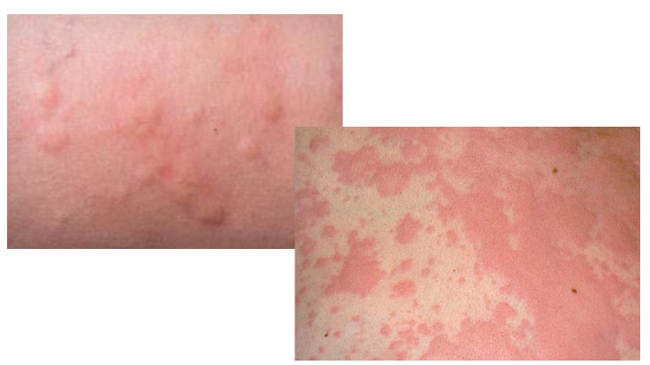 <ol><li><p>skin lesion = </p></li><li><p>secondary to ______</p></li><li><p>usually ______</p></li></ol><p></p>