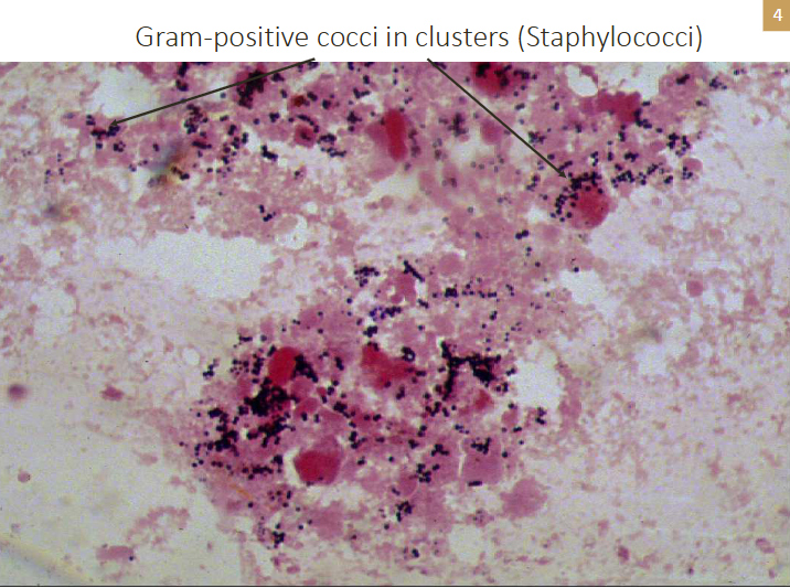 <p>Gram positive cocci in clusters (staphylococci)</p>