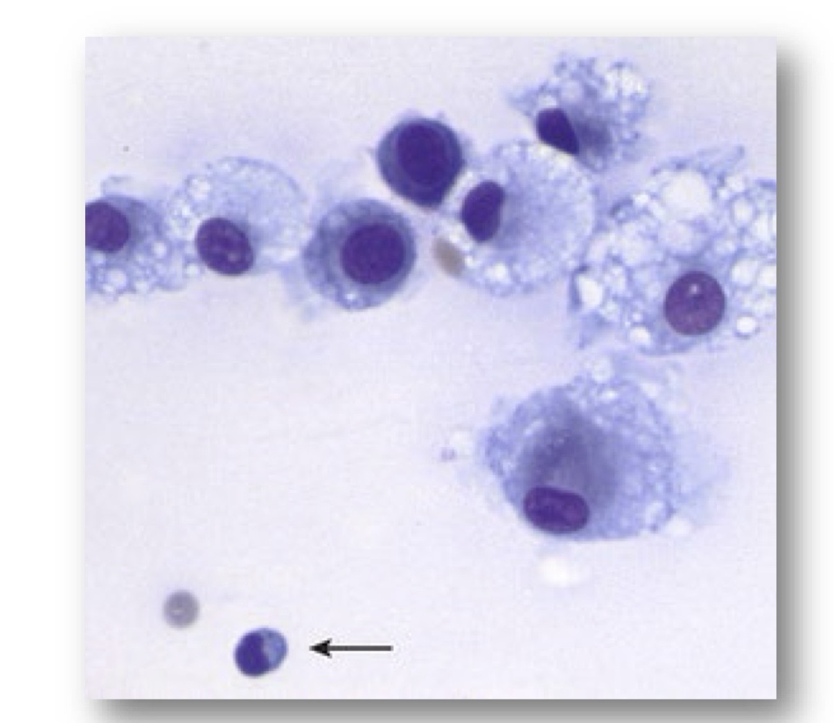 <p>name a common joint disease that is consistent with this cytology?</p>