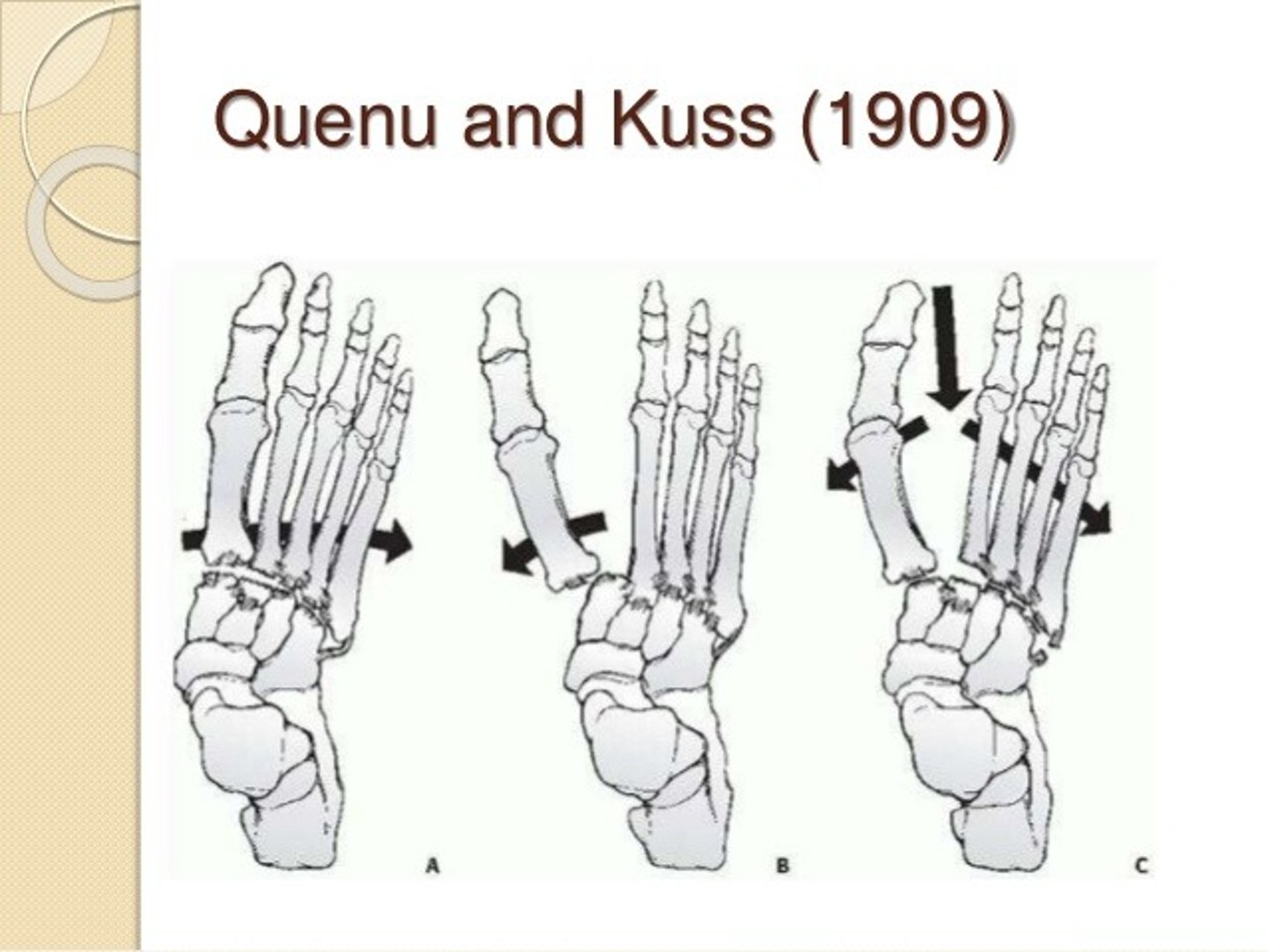 <p>Lisfranc Dislocation</p><p>Convergent homolateral</p><p>All metatarsals subluxed laterally</p><p>All 5 metatarsals displaced laterally in the transverse plane</p><p>Isolateral</p><p>1st metatarsal subluxed medially or metatarsals 2-5 subluxed laterally</p><p>1 or 2 metatarsals displaced laterally in the transverse plane</p><p>Divergent</p><p>1st metatarsal subluxed medially and metatarsals 2-5 subluxed laterally</p><p>Displacement in both sagittal and transverse planes</p>