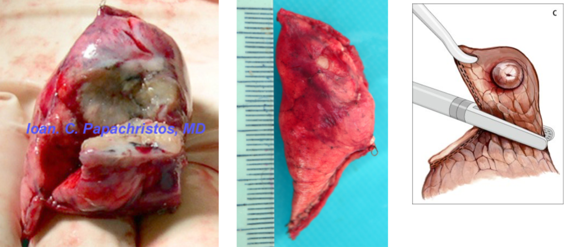<p>Staple-line excision of peripheral nodule</p><p>Triangular piece of lung parenchyma</p><p>Usually for non-tumor reasons</p>