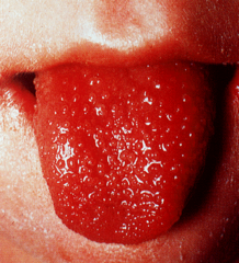 <p>blanching, sandpaper rash, strawberry tongue, treated with abx</p><p>-hx of pharyngitis</p>