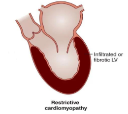 <p><span>What is <em>Restrictive Cardiomyopathy (RCM)</em>?</span></p>