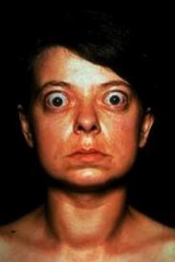 <p>a disorder caused by a thyroid gland that is faster than normal and overly productive; results in a rapid pulse, nervousness, and loss of weight</p>