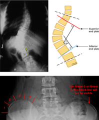 <p>- X-ray: AP/Lat entire T/L spine</p><p>- Measure Cobb Angle (>10º = scoliosis)</p><p>- Riesser Sign (eval of bone age). More concerning if they're still growing.</p><p>MRI only if + neuro findings (or red flag sx)</p>