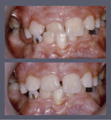 <p>Correction of an anterioir crossbite is only stable if what is present?</p>