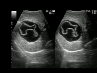 <p>Most common caused by Taenia echinococcus or Echinococcus granulosus—parasitic tapeworm</p>