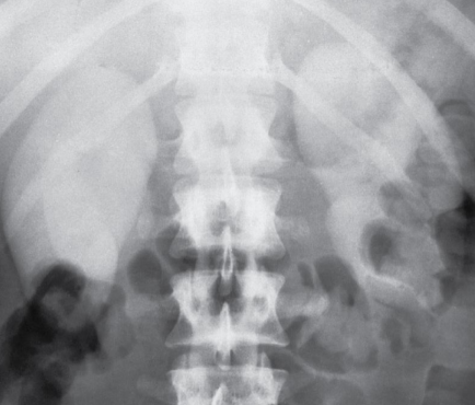 <p>Rapid deterioration in kidney function</p><ul><li><p>Results in accumulation of nitrogen-containing wastes</p></li><li><p>Caused by impaired blood flow, infection to kidneys, ureteral obstruction, Tylenol overdose</p></li></ul><p></p>