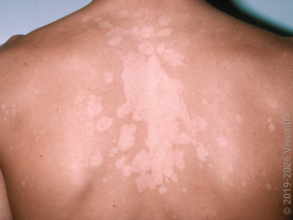 <p>Tinea versicolor</p>