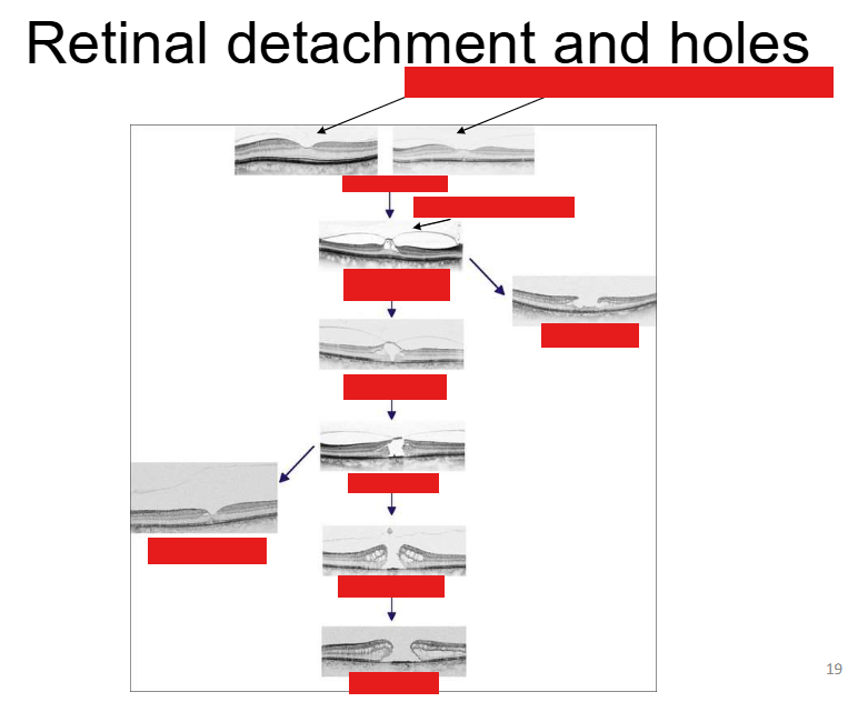 <p>Stages of a macula hole</p>