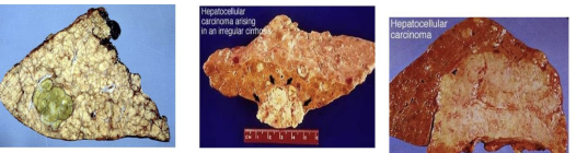 <p>Arises in irregular cirrhosis. </p><p>Forms: </p><ol><li><p>Single large well-defined mass with hemorrhage &amp; necrosis. </p></li><li><p>Multiple small nodules scattered all over liver sparing periphery. </p></li><li><p>Diffuse infiltration. Tissue is yellow-white and may be bile-stained (green).</p></li></ol><p></p>