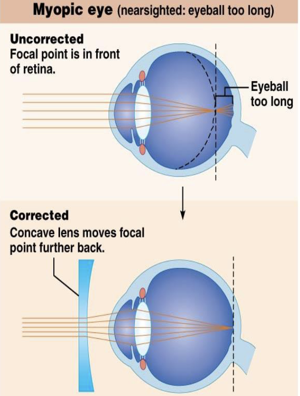 <p>XII. Refraction Problems </p><p>Myopia</p><ul><li><p>What is myopia?</p><ul><li><p>What causes myopia according to the lecture?</p><ul><li><p>Where is the focal point in myopia?</p><ul><li><p>What type of lens corrects myopia?</p></li></ul></li></ul></li></ul></li></ul><p></p>
