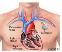 <ul><li><p>can be used when the conduction system fails</p></li><li><p>stimulus of SA or AV node damaged (sets up electrical current to reestablish HR)</p></li></ul><p></p>