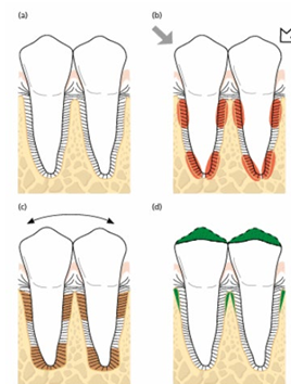 <p>-jiggling forces mimic human occlusal forces</p><p>-PDL adapts and widens</p><p>-once occlusal trauma force is removed, will go back to normal</p><p>-there is no bone loss</p>