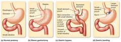 <p>By restricting stomach capacity, creating malabsorption, or a combination of both.</p>