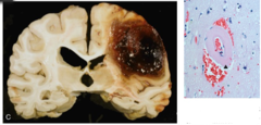 <p>What hemorrhage pattern is typical of CAA?</p>