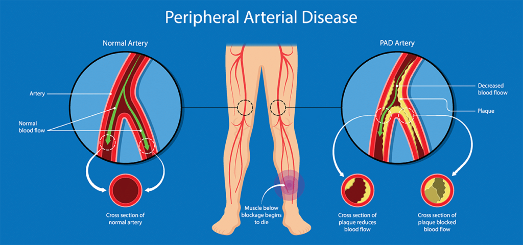 <p>A condition in which the arteries that supply blood to the limbs (usually the legs) become narrowed or blocked, reducing blood flow.</p>