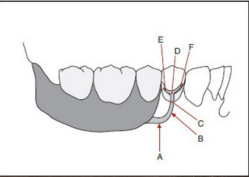 <p>Type of infrabuldge clasp shown</p>