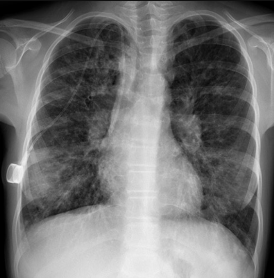 <p>What’s wrong with this CXR?</p>